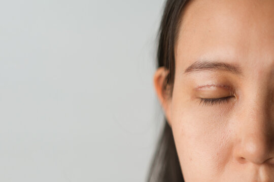 Asian woman with upper blepharoplasty surgery concept. Medical double eyelid plastic surgery, face view closing eyes with bruises and stitching on the eyelids. white background blank copyspace.