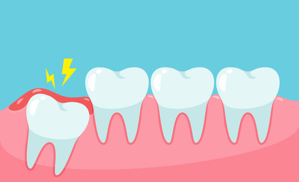 Impacted wisdom tooth cause pain in the mouth.Dental care concept