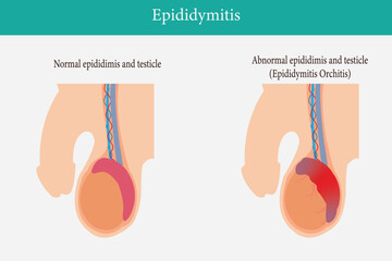 two illustration comparation of normal epididimis and testis, and abnormal epididimis and testis (epididimitis orchitis). eps 10 - obrazy, fototapety, plakaty
