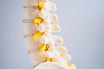 Lumbar spine displaced herniated disc fragment, spinal nerve and bone. Model for treatment medical in the orthopedic department.