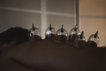 Close up of back athletic man lying down with vacuum cups in medical clinic dark room, visit...