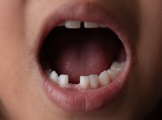 Baby baby teeth with one missing tooth. the concept of caring for children's teeth.
