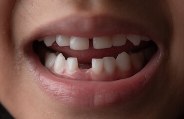 Baby baby teeth with one missing tooth. the concept of caring for children's teeth.