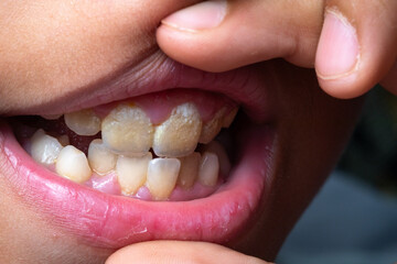 Child's teeth neglected, with plaque and tartar
