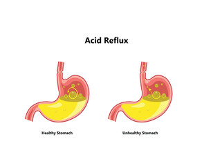 Reflux or gastroesophageal reflux, Heartburn. Stomach disease, stomach problem disease concept. Vector drawing