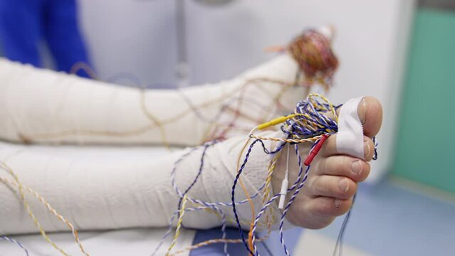 Patient's legs covered in bandages with some wires around. Close up. Neuromonitoring in modern hospital.