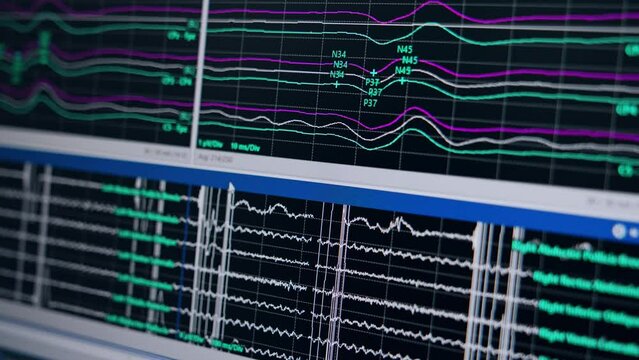 Brain work curves on the computer monitor. Close up. Neuromonitoring in treating neurologic issues.