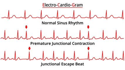 Set of ECG Common Abnormalities - Junctional Escape Beat - Premature Junctional Contraction PJC - Electrocardiogram Vector Medical Illustration