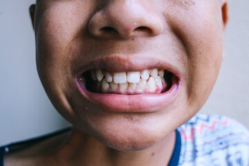 Close up of boy teeth. Kid patient open mouth showing cavities teeth decay.