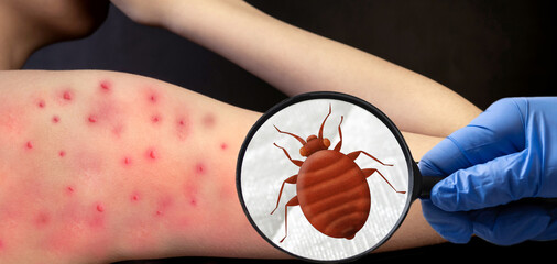 Bedbug bite on the human body. Itchy, red spots on the skin caused by insect bites. Cimex...