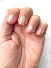 broken and damaged female nails after removing hybrid manicure