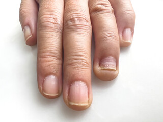 Fungal infection on weak sore female fingernails.