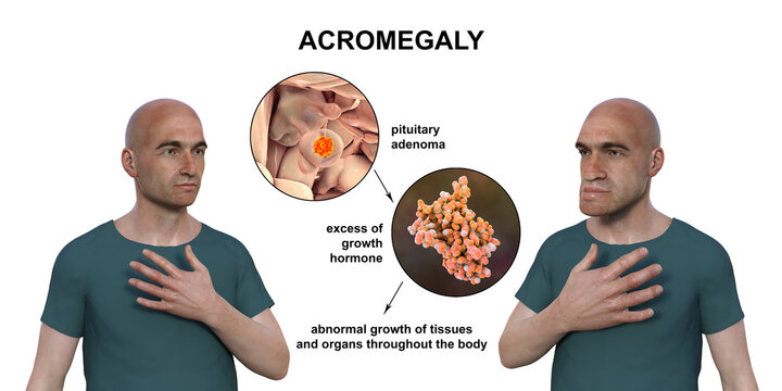 Acromegaly, 3D illustration