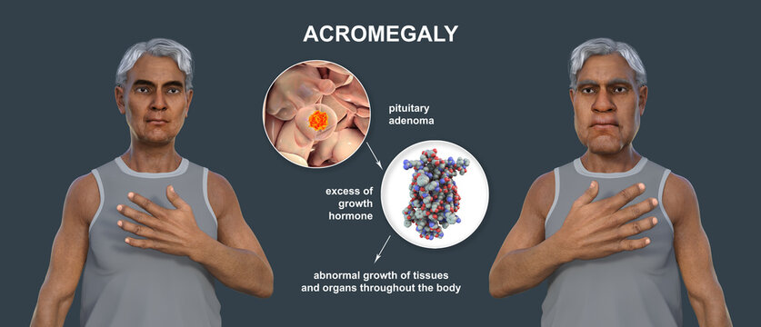 Acromegaly, 3D illustration