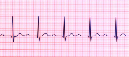 An ECG displaying 1st degree AV block, 3D illustration