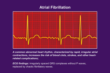 ECG in atrial fibrillation, 3D illustration - obrazy, fototapety, plakaty