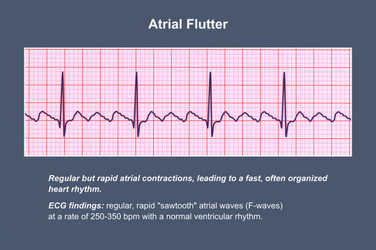 ECG in atrial flutter, an abnormal heart rhythm characterized by rapid, regular contractions of the atria, 3D illustration
