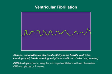 ECG displaying the chaotic rhythm of ventricular fibrillation, 3D illustration