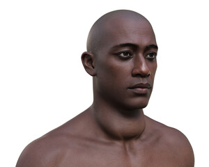 A man with enlarged thyroid gland, 3D illustration - obrazy, fototapety, plakaty