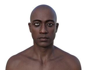 A man with hypertropia, 3D illustration