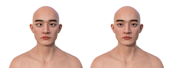 A man with esotropia and the same healthy man, 3D illustration - obrazy, fototapety, plakaty