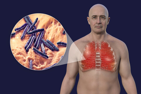 A man with the lungs affected by miliary tuberculosis, and close-up view of Mycobacterium tuberculosis bacteria, 3D illustration