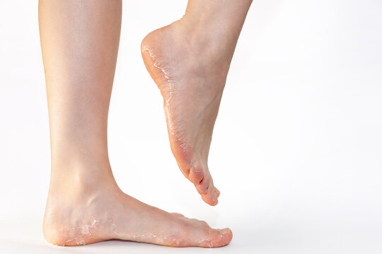 Side view of female legs with flaky skin heels. Copy space. White background. Skin care and pedicure