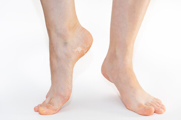 Close up of female legs with peeling skin of soles on heels. White background. Skin care concept
