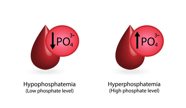 Hyperphosphatemia, high plasma phosphate level and Hypophosphatemia, low plasma phosphate level. phosphate excess and deficit electrolyte disorders, blood droplet, Scientific Vector illustration.