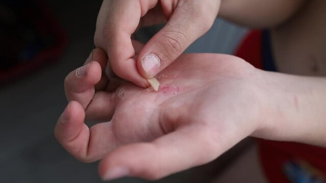 touches a callus on his palm from hard work. Street workout, torn skin on my palm.