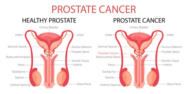 Prostate cancer. Male reproductive system. Anatomy of the internal organs of man. Infographic banner, diagram, vector