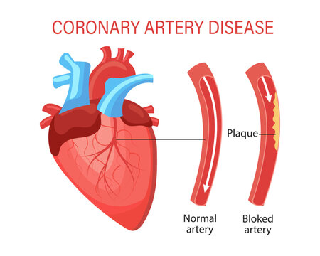 Disease of the coronary artery of the heart. Human anatomy, medical concept. Infographics, banner, vector