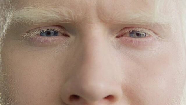 Marco close up blue eyes of handsome albino man. Calm relaxed man looking at camera. Male model with discolored hair pale skin. Concept of diversity, equality and people of different ethnicity 4K