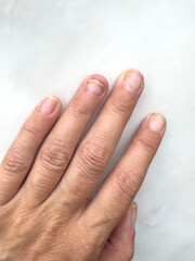 broken fingernail of a woman with infection  on white
