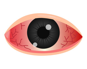 red eye conjunctivitis. vector illustration