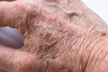Close up of the wrinkled skin on the hand of an older man with some lesions of actinic keratosis or sunspots - obrazy, fototapety, plakaty