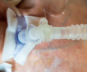 ICU at the hospital. Tracheostomy or tracheotomy is a bypass airway surgery due to breathing...