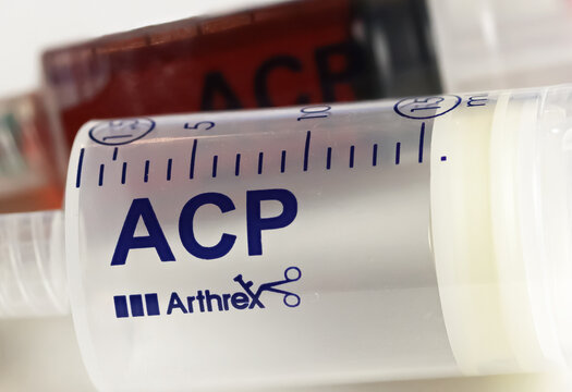 Viersen, Germany - October 9. 2023: Closeup of Arthrex ACP double syringe for production of autologous platelet rich plasma, PRP, from own blood