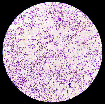 Bacterial colonies gram stained microscopic show Staphylococcus aureus  Bacteria.