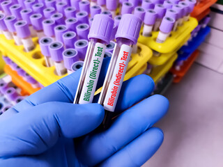 Blood sample for Bilirubin Direct and Indirect test. To diagnosis jaundice 