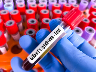 Obraz premium Blood sample for Gilbert Syndrome testing at medical laboratory.