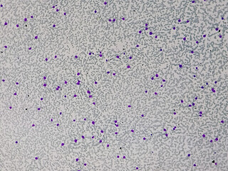 Acute myeloid leukemia (AML) is a type of blood cancer. Microscopic 10x examination of blasts or leukemia cells in blood smear of human.