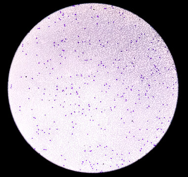 Acute myeloid leukemia (AML) is a type of blood cancer. Microscopic 10x examination of blasts or leukemia cells in blood smear of human. 10 X objectives 