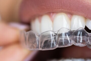 Clear Aligners and Dental Night Guard