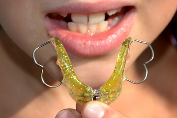 Teenager wearing orthodontic appliance dental treatment to improving bite gap.
