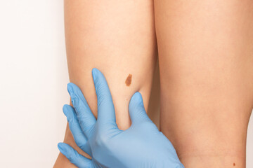A large mole or birthmark on a child's leg. A doctor wearing medical gloves examines a dark brown...