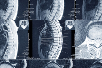 MRI scan of the thoracic spine for diagnosis. Medical examination
