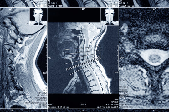 MRI scan of the cervical spine for diagnosis. Medical examination