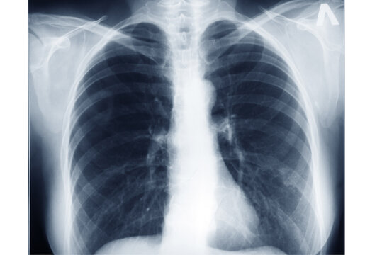 photo X-ray scan of the chest area. Lung radiography