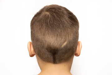 Small scar on the back of a child's head, isolated on a white background. Damage to the scalp as a result of injury or accident. Close-up, rear view. Medical surgical care concept